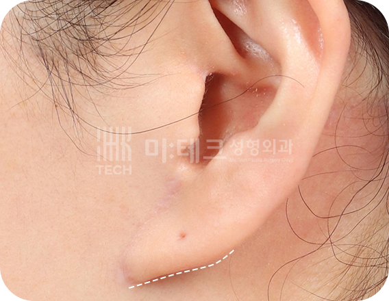 칼귀 교정 전 사진