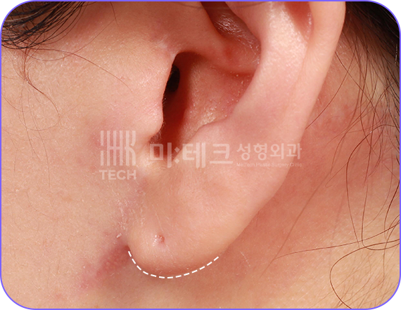 칼귀 교정 후 사진