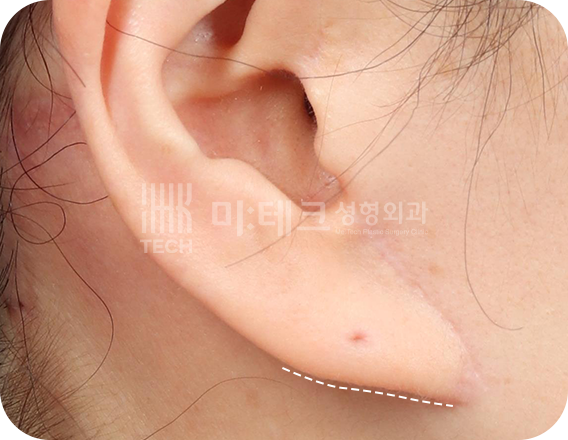 칼귀 교정 전 사진