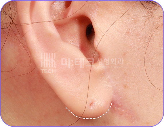 칼귀 교정 후 사진