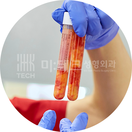 지방이식