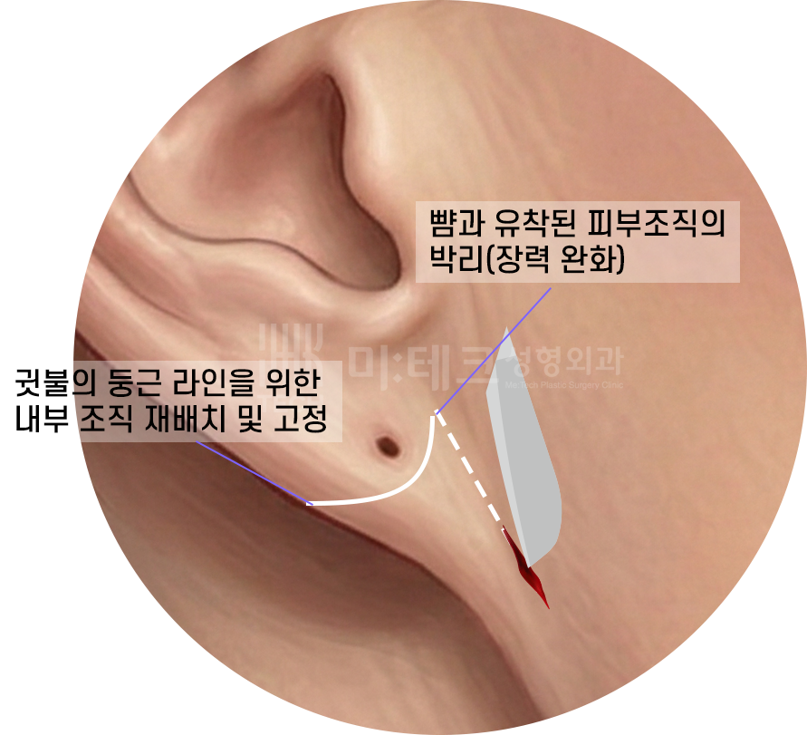 칼귀 교정 절개 과정