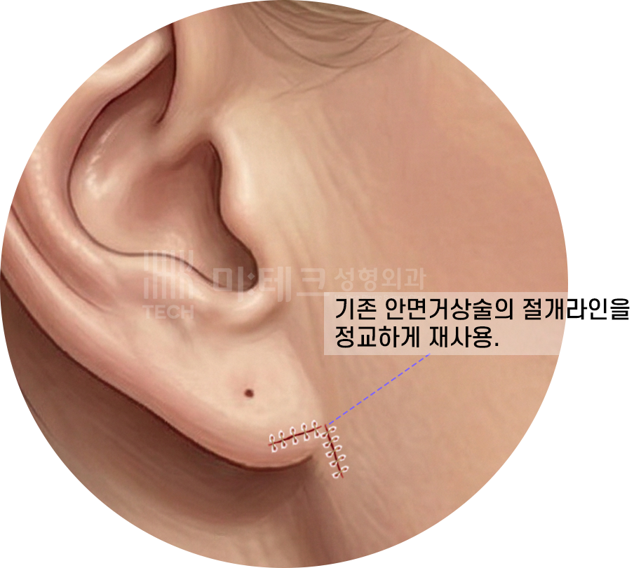 칼귀 교정 봉합 과정