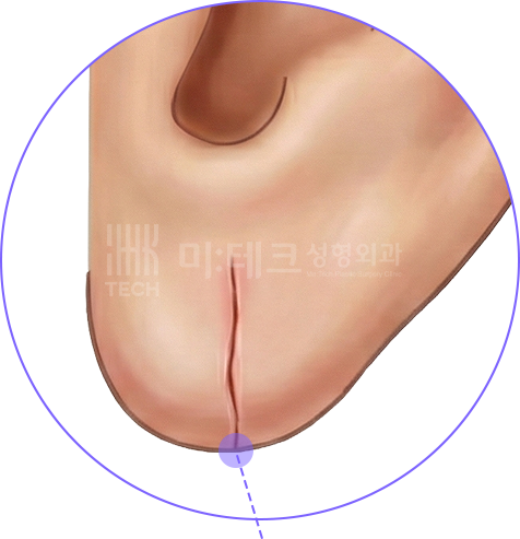 늘어진 귀걸이 구멍