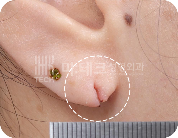이수열 수술 전 사진