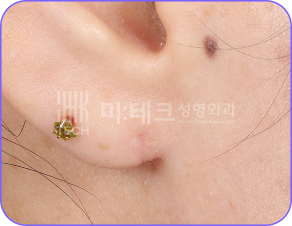 이수열 수술 후 사진