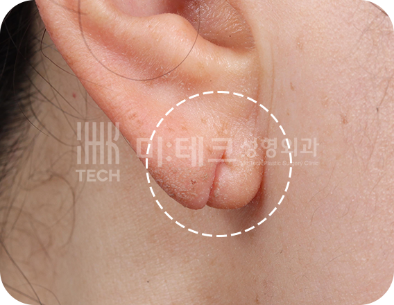 이수열 수술 전 사진