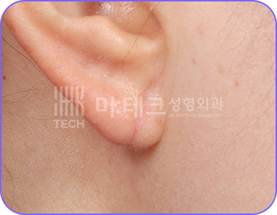 이수열 수술 후 사진