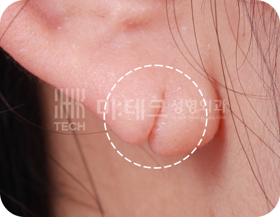 이수열 수술 전 사진