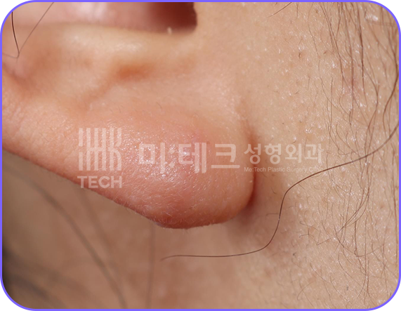 이수열 수술 후 사진