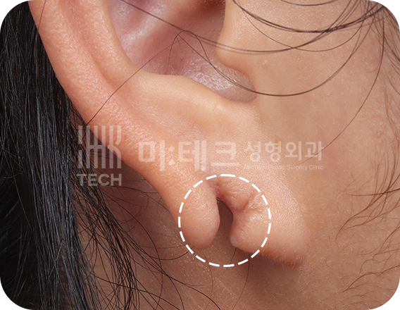 이수열 수술 전 사진