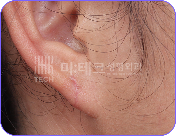 이수열 수술 후 사진