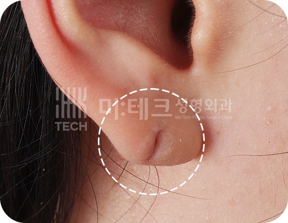 이수열 수술 전 사진