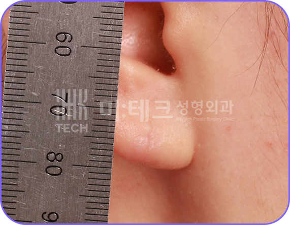 이수열 수술 후 사진