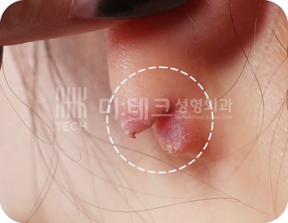 이수열 수술 전 사진