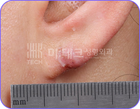 이수열 수술 후 사진