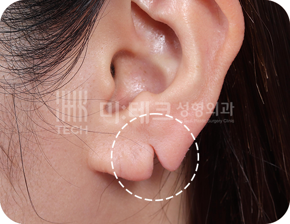 이수열 수술 전 사진