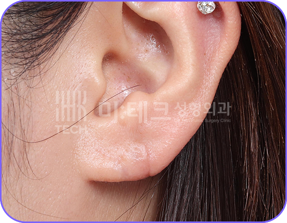 이수열 수술 후 사진