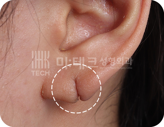 이수열 수술 전 사진