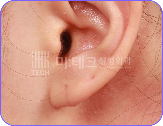 이수열 수술 후 사진