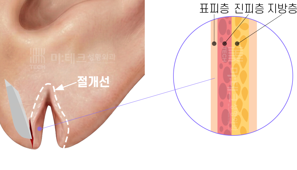 이수열 절개 과정과 피부층 구조