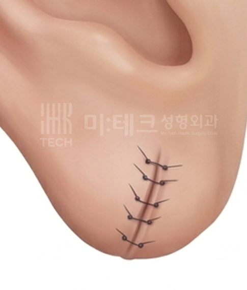 이수열 앞면 봉합