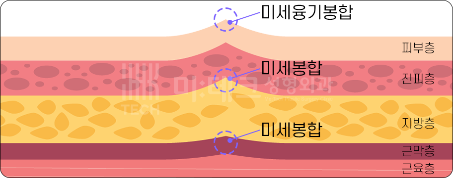 미세봉합 과정