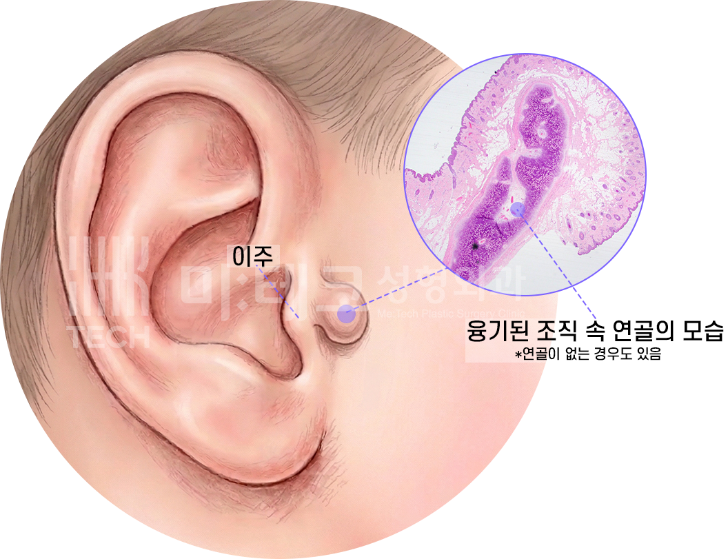 스킨텍 발생 위치