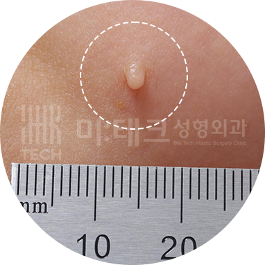 볼 스킨텍
