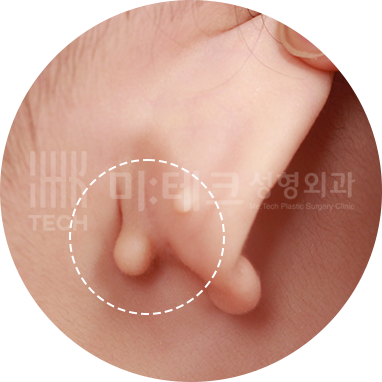 귀 뒤와 목의 스킨텍