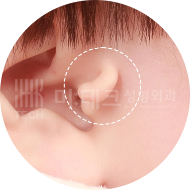 단발성 스킨텍