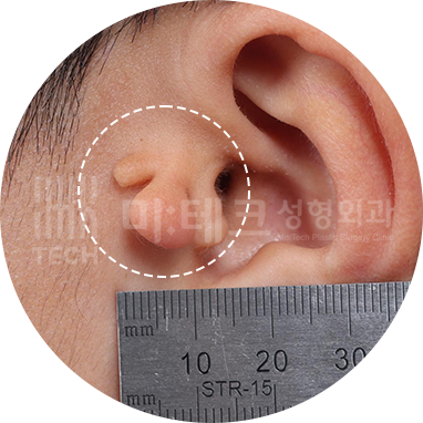 다발성 스킨텍