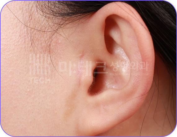 스킨텍 수술 10개월 후 2024.04.30