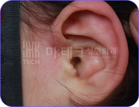 스킨텍 수술 약 1년 후 2026.03.10