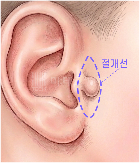 스킨텍 절개선