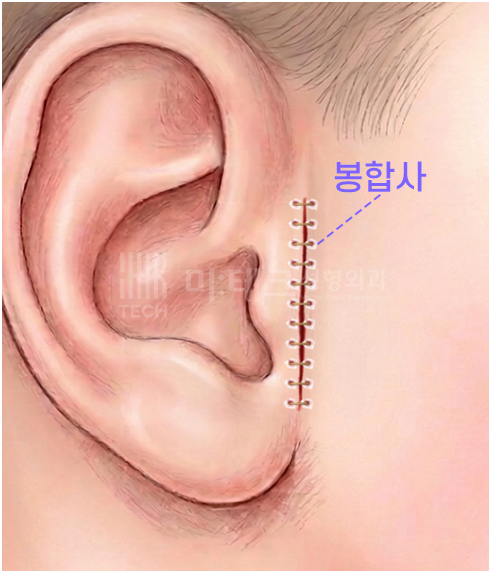 스킨텍 미세봉합
