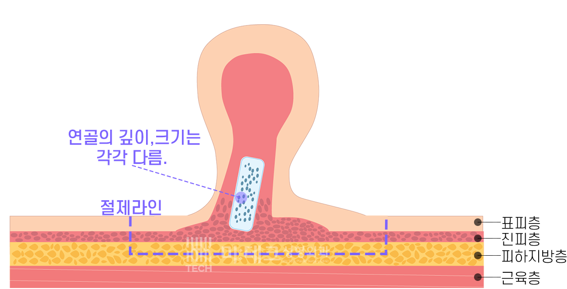 스킨텍의 피부층과 연골 구조
