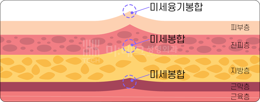 흉터 최소화를 위한 층별 미세봉합