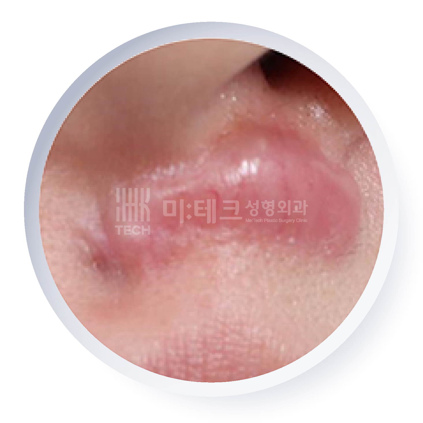성숙 흉터