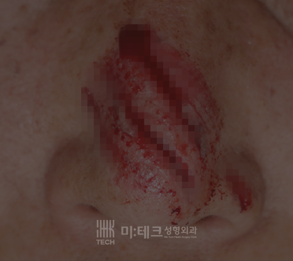 봉합수술전