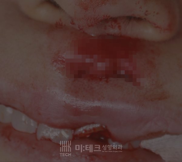 봉합수술전