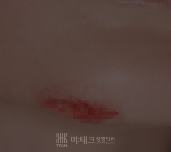 봉합수술전