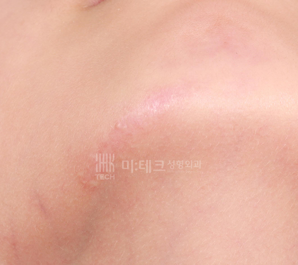 흉터치료후
