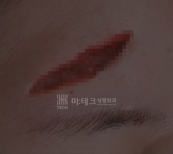 봉합수술전