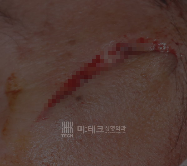 봉합수술전