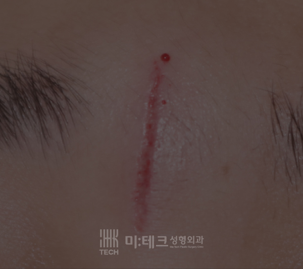 봉합수술전